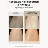 Professional Laser Epilator IPL Hair Removal Body Bikini Leg