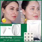 Acne Pimple Healing Patch