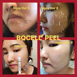 BQ Cell Derma Skin Peeling