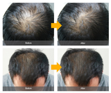 MBA Hair Loss Treatment