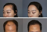 A PROGEN Hair Loss Korea